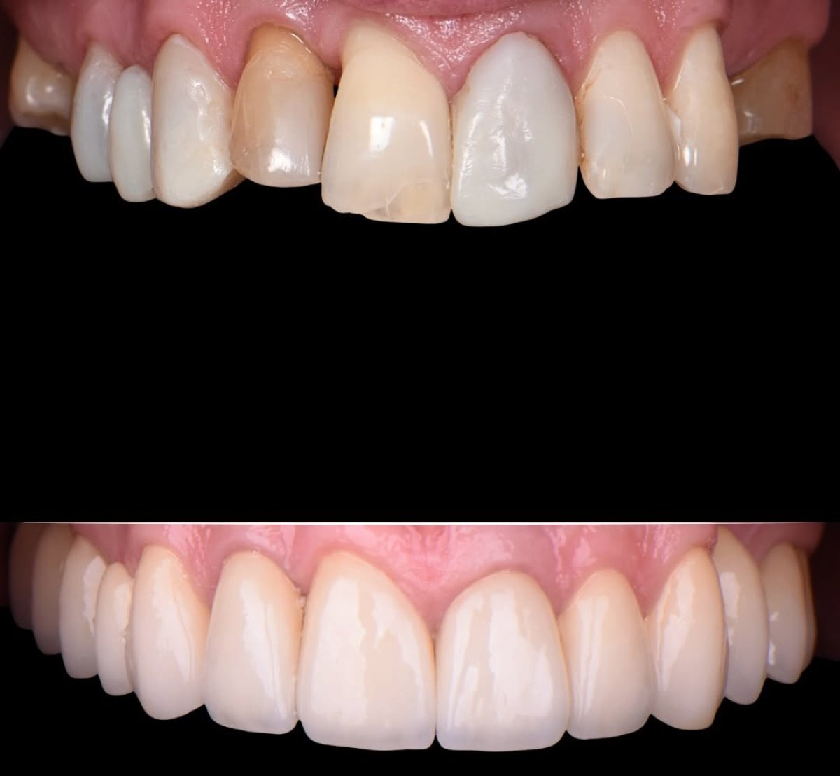 Before and after tooth whitening results – visibly brighter smile after procedure