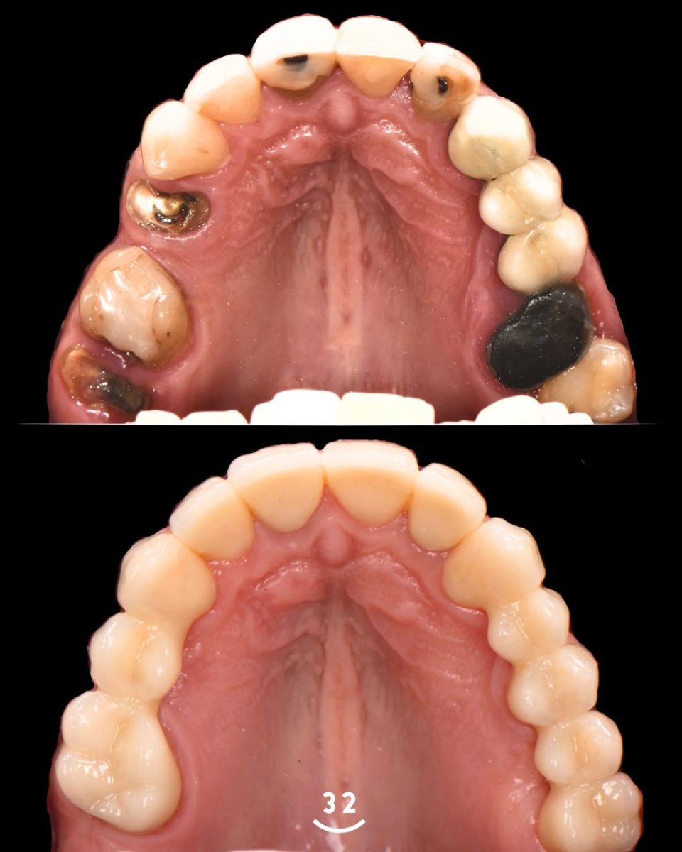 Before and after tooth prosthesis results – restored upper teeth and improved dental health