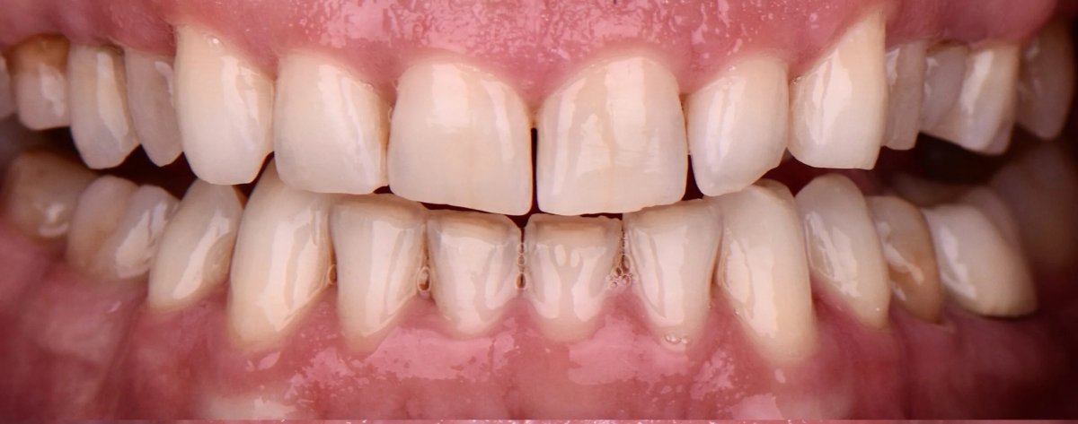 Gingival recession plastic surgery result – improved gum line and healthier smile