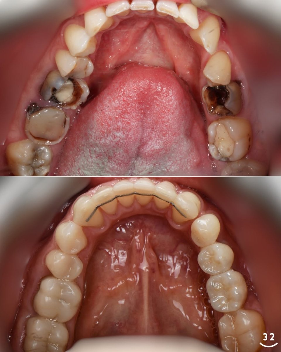 Before and after dental crown installation results – restored upper teeth and improved smile