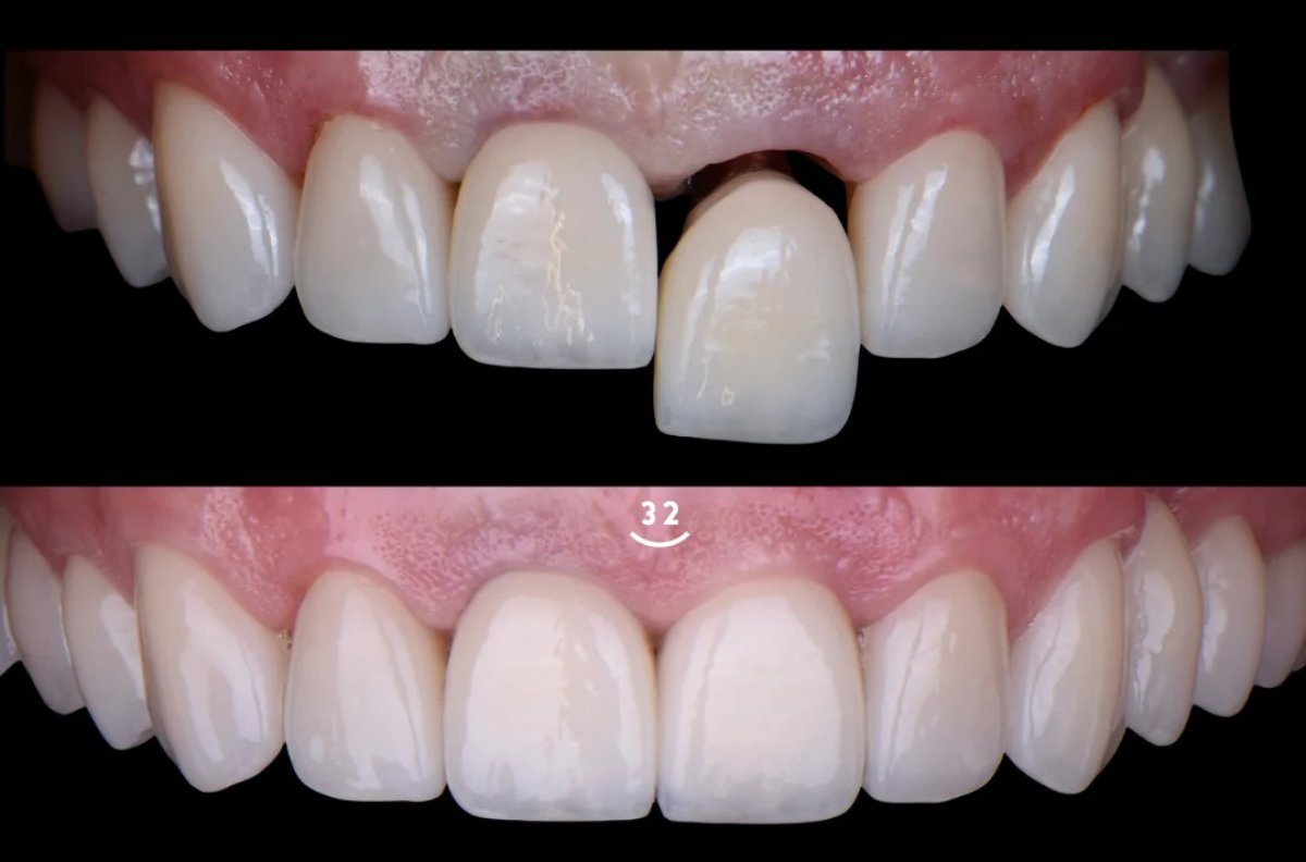 Before and after dental implant with abutment results – restored front tooth and smile