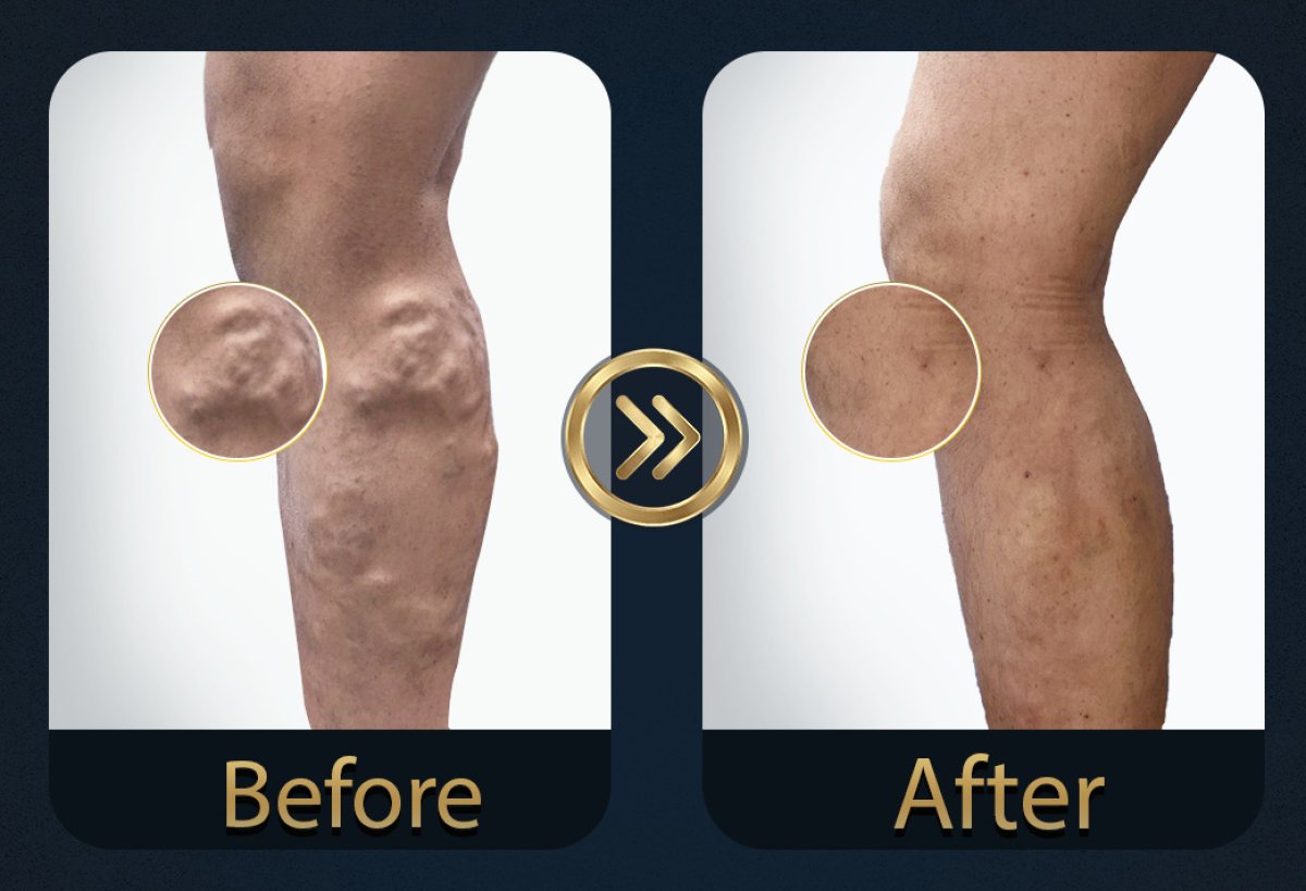 Before and after sclerotherapy results for varicose veins, visible leg vein improvement