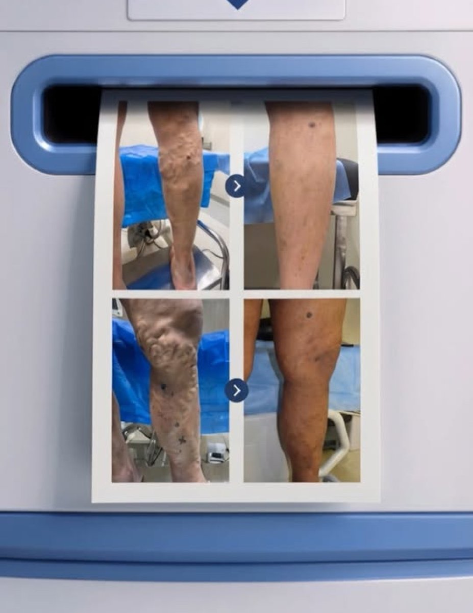 Before and after varicose veins removal results – improved leg appearance after treatment