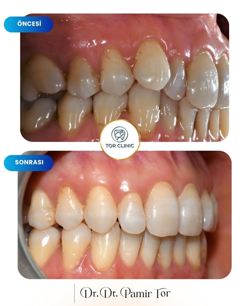 E-motion Aligners before and after results at Tor Clinic – improved teeth alignment