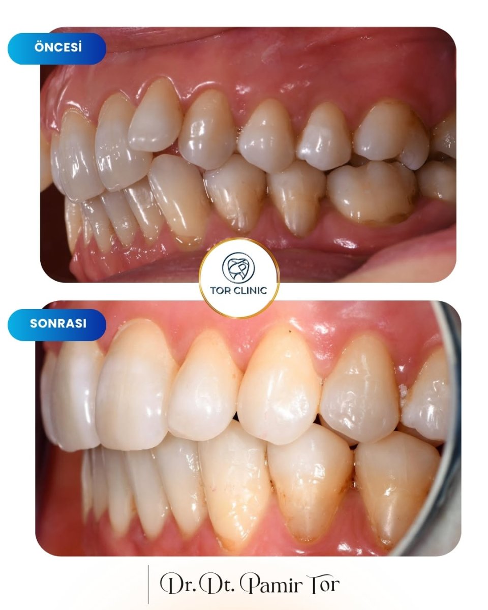 Efekty przed i po E-motion Aligners w Tor Clinic – poprawa ustawienia zębów