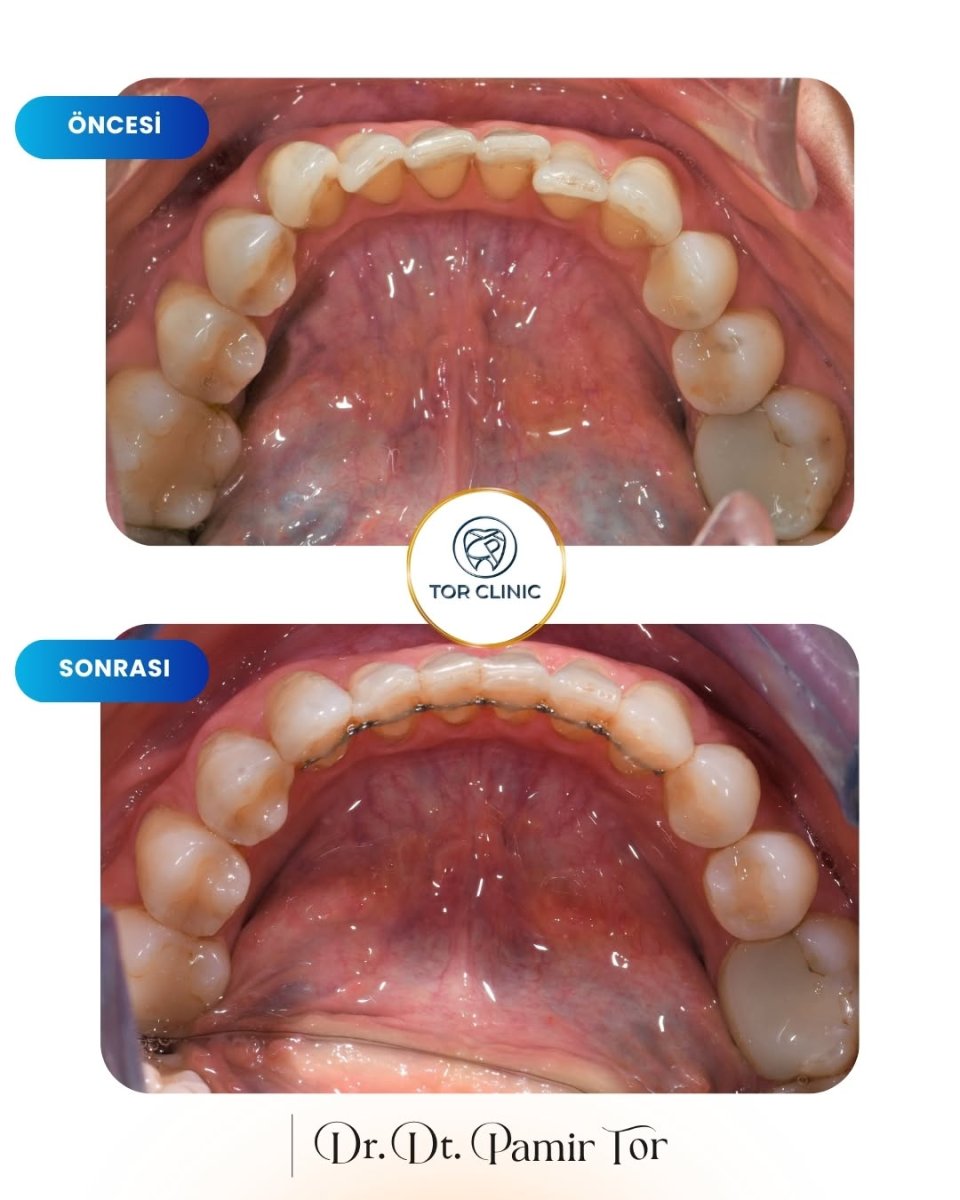 E-motion aligners before and after results at Tor Clinic – improved teeth alignment
