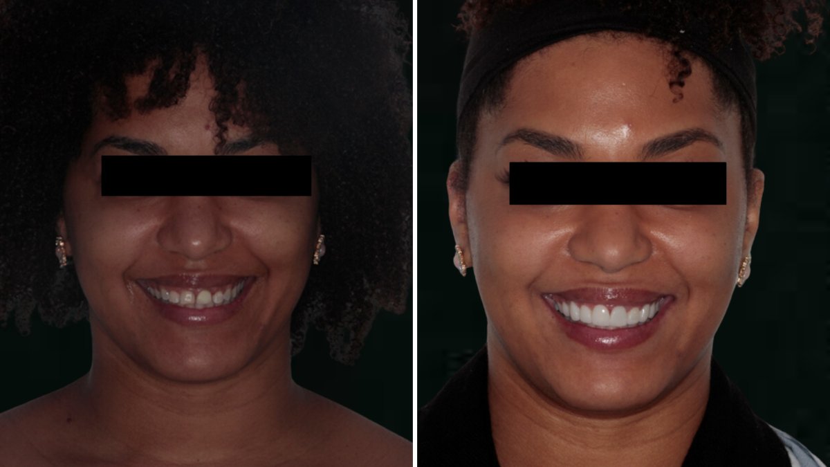 Before and after veneers result – smile transformation with whiter, even teeth