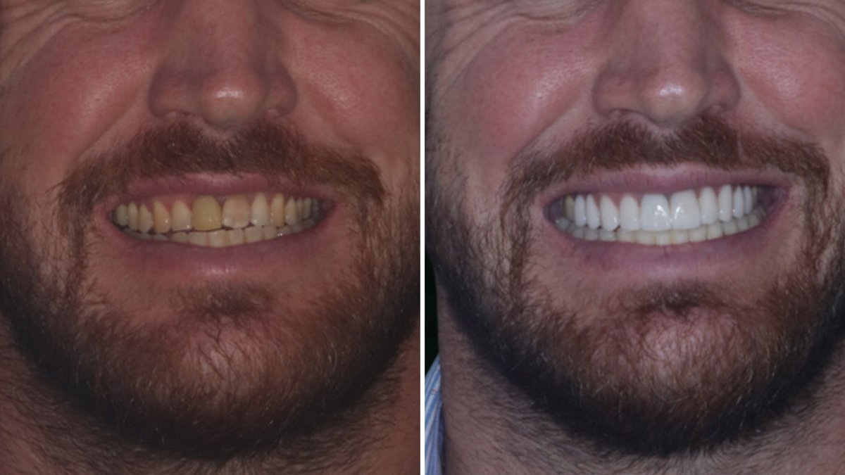 Hollywood Smile przed i po – bielsze, równe zęby po założeniu licówek