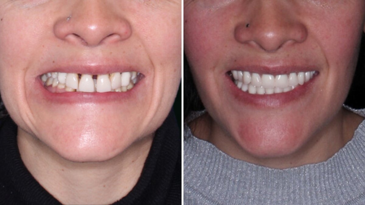Результати до і після Hollywood Smile – вініри для білих і рівних зубів