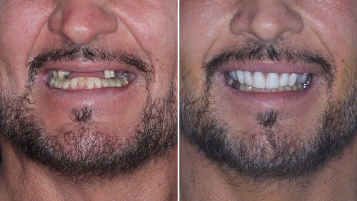Vorher-nachher-Ergebnis Hollywood Smile – Implantate und Veneers für neues Lächeln