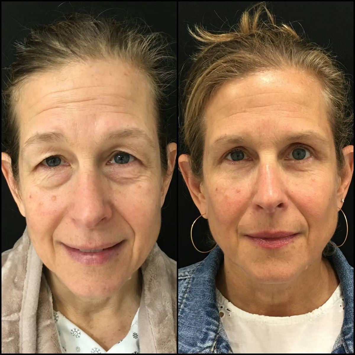 Before and after upper and lower eyelid surgery results at Optimed International Hospital
