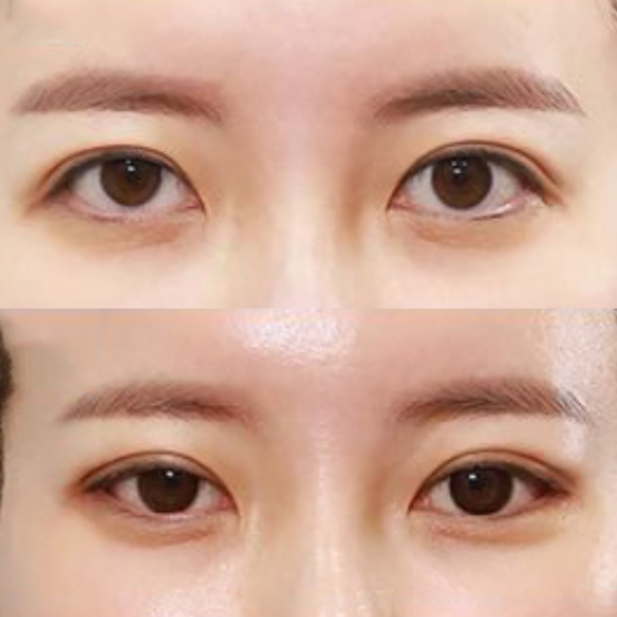 Before and after Fox Eye Lift results at Returning Plastic Surgery, lifted eyelid appearance