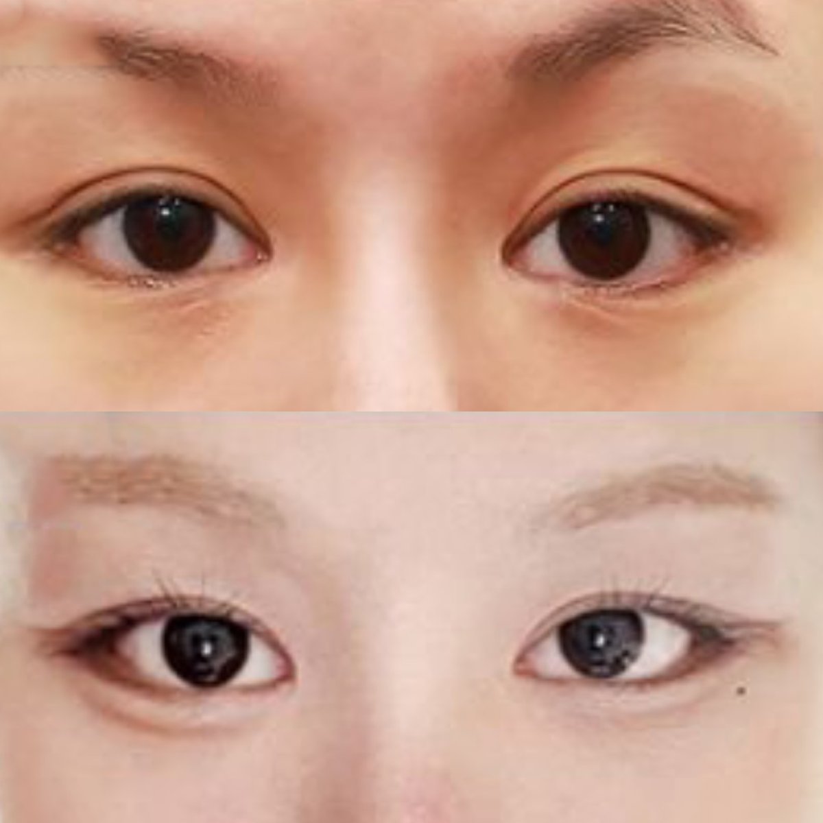 Fox Eye Lift before and after results at Returning Plastic Surgery, lifted eye contour visible