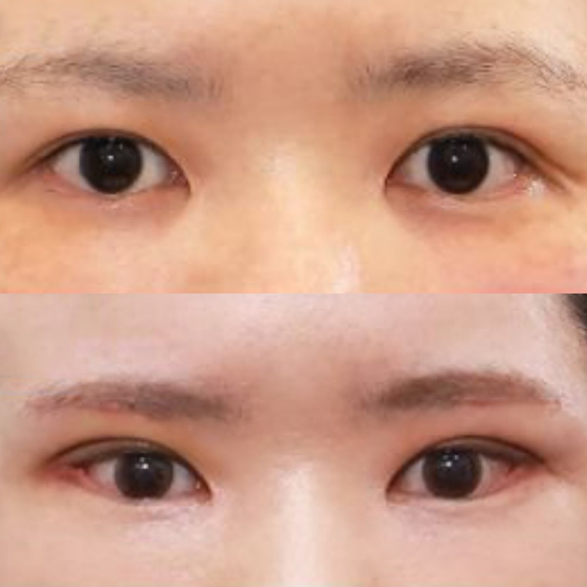 Before and after Fox Eye Lift results at Returning Plastic Surgery, lifted eyelid appearance