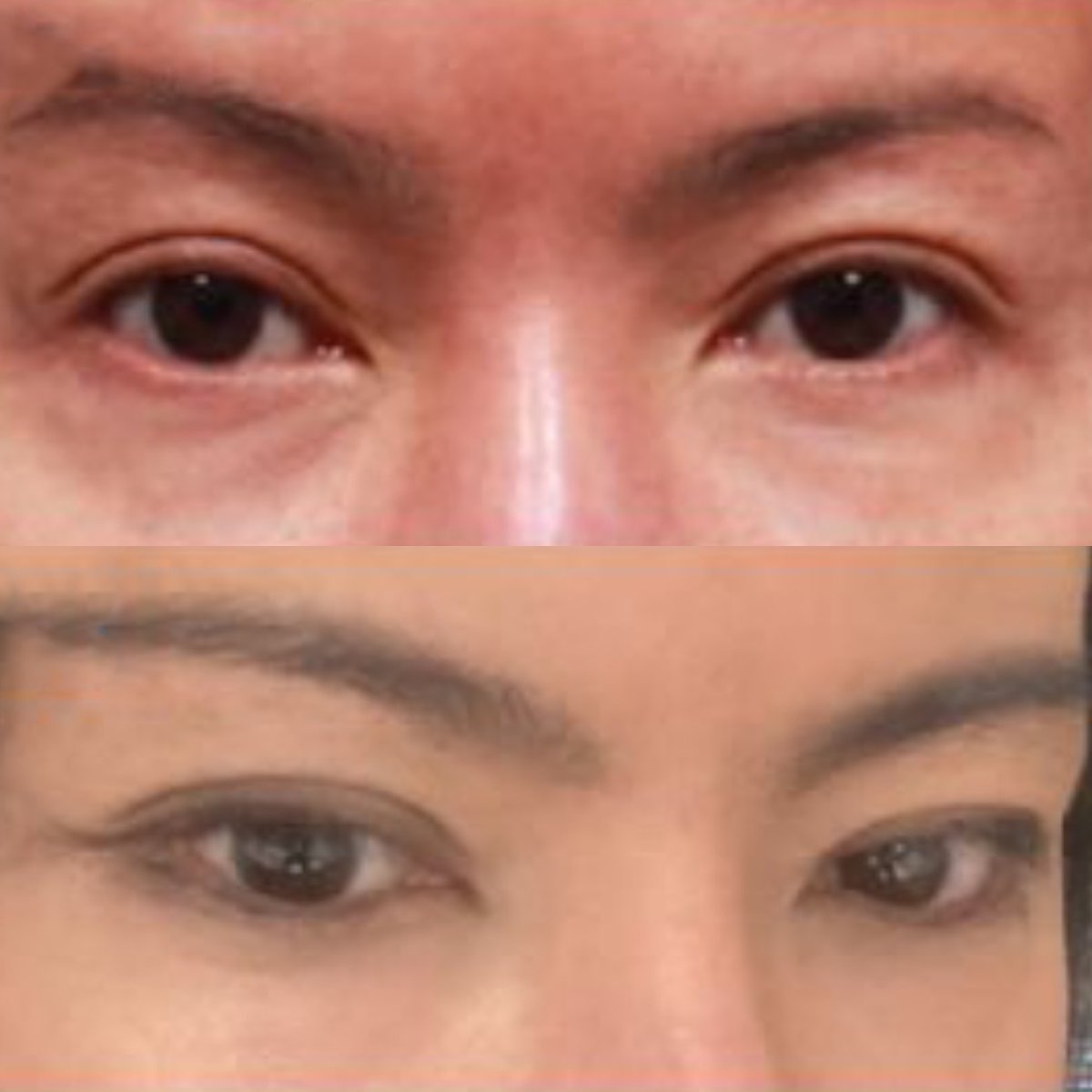 نتائج قبل وبعد Fox Eye Lift في Returning Plastic Surgery، رفع محيط العين