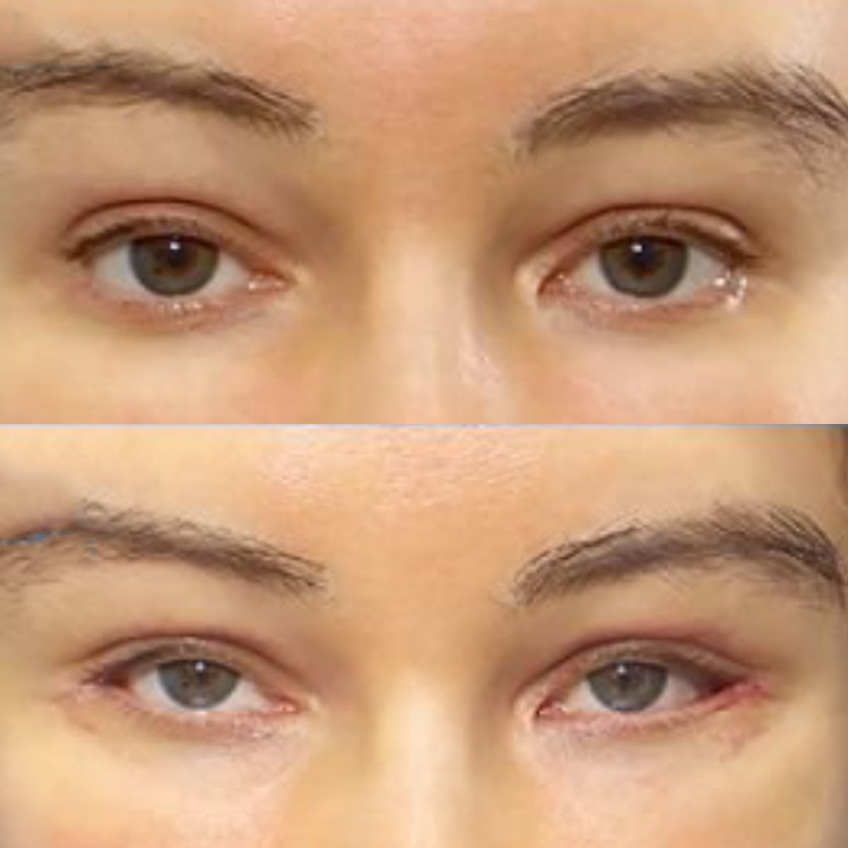 Before and after Fox Eye Lift results at Returning Plastic Surgery, enhanced eye contour