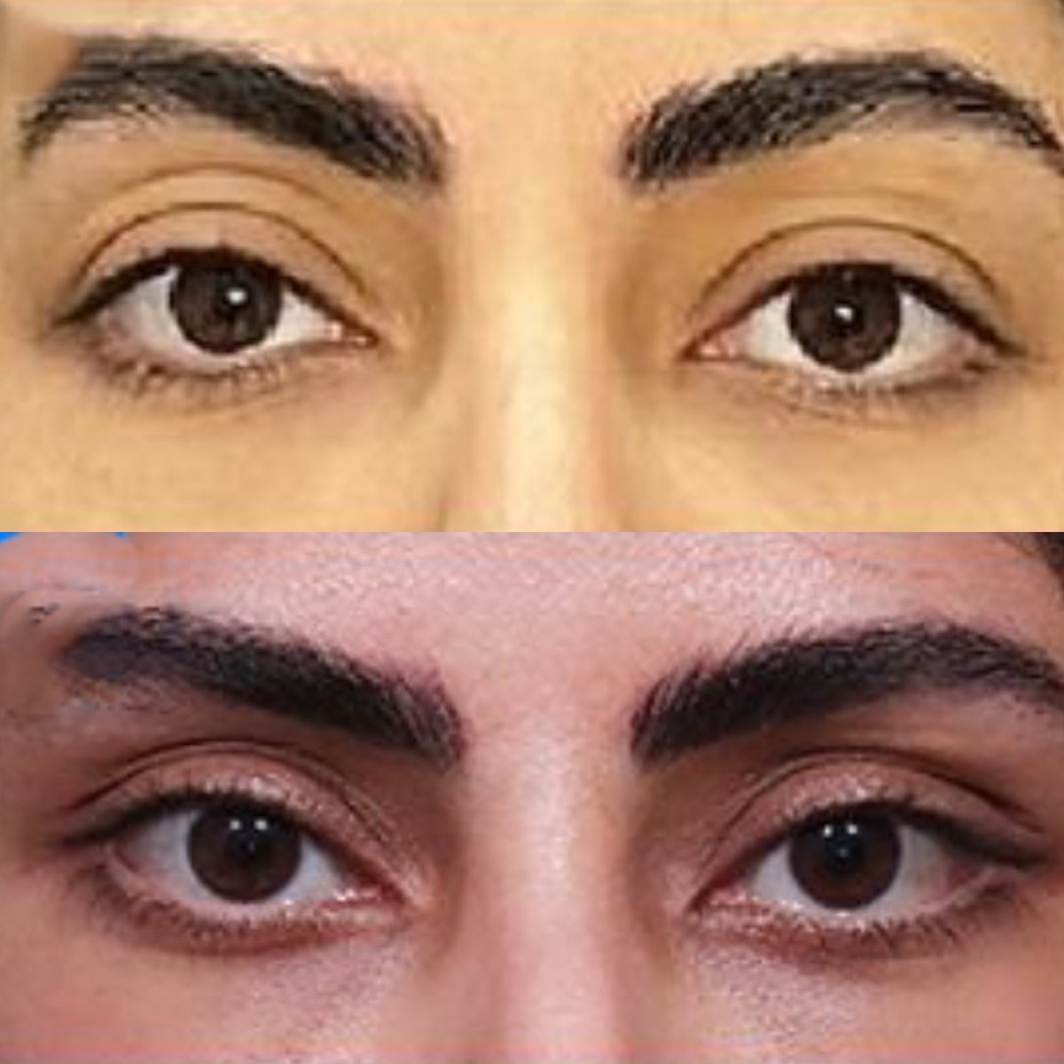 Before and after Fox Eye Lift results at Returning Plastic Surgery, lifted eye contour visible