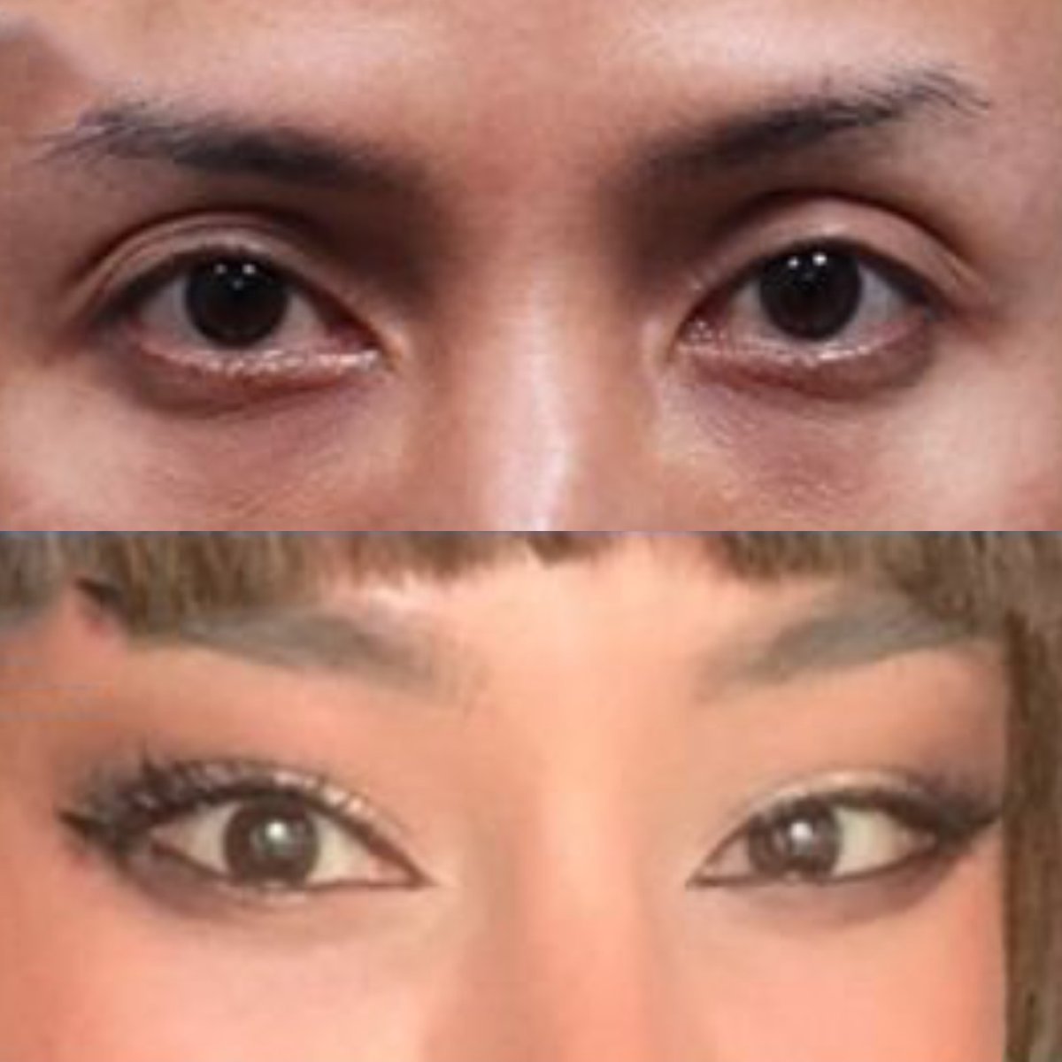 Before and after Fox Eye Lift results at Returning Plastic Surgery, enhanced eye shape