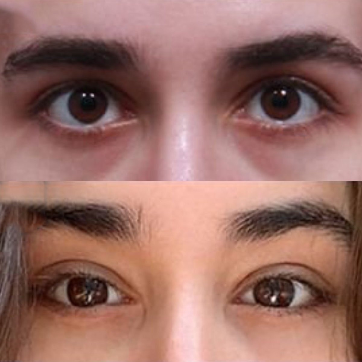 Before and after Fox Eye Lift results at Returning Plastic Surgery, enhanced eye contour