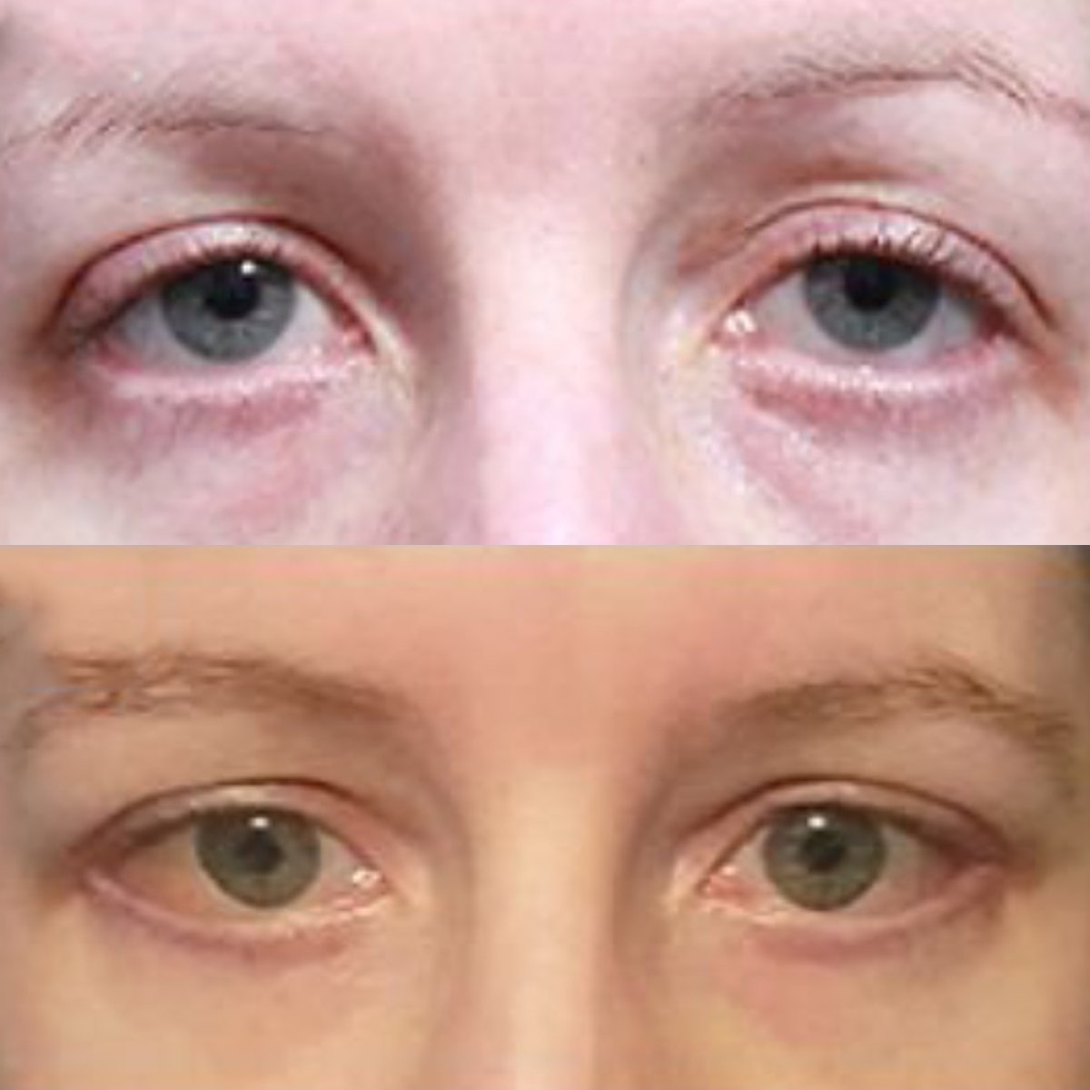 Before and after Fox Eye Lift results at Returning Plastic Surgery, lifted eyelid appearance