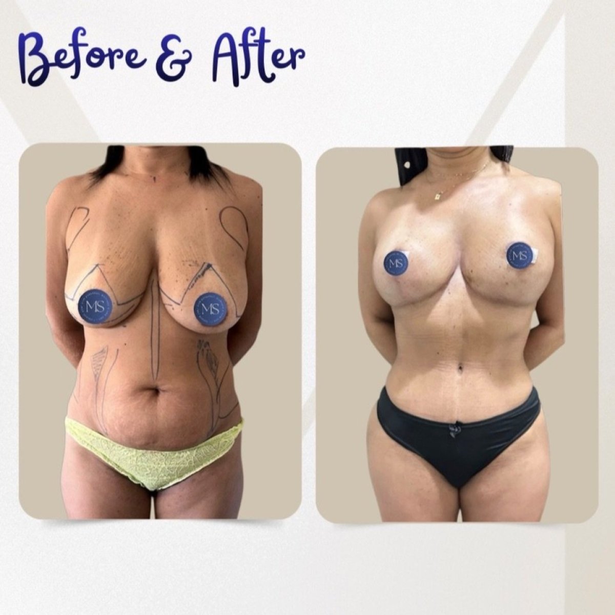 Resultados de liposucción antes y después en Dr. Michel Salameh - Plastic And Aesthetic Surgery