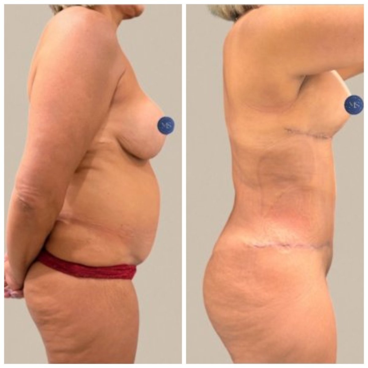 Результати ліпосакції до і після в клініці Dr. Michel Salameh - Plastic And Aesthetic Surgery
