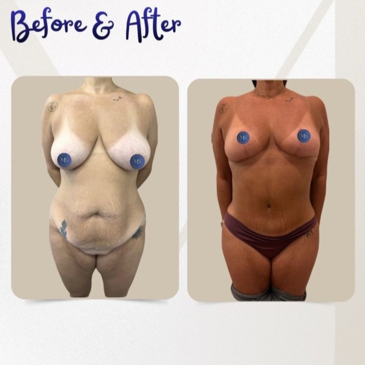 نتائج شفط الدهون قبل وبعد في عيادة Dr. Michel Salameh - Plastic And Aesthetic Surgery