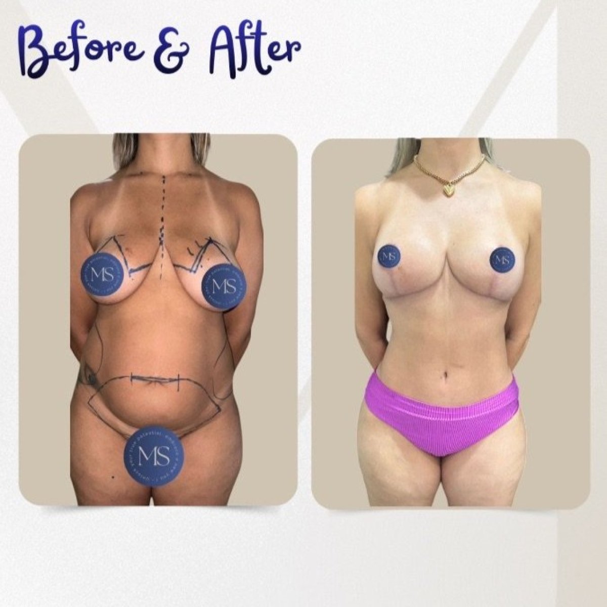 نتائج شفط الدهون قبل وبعد في عيادة Dr. Michel Salameh - Plastic And Aesthetic Surgery