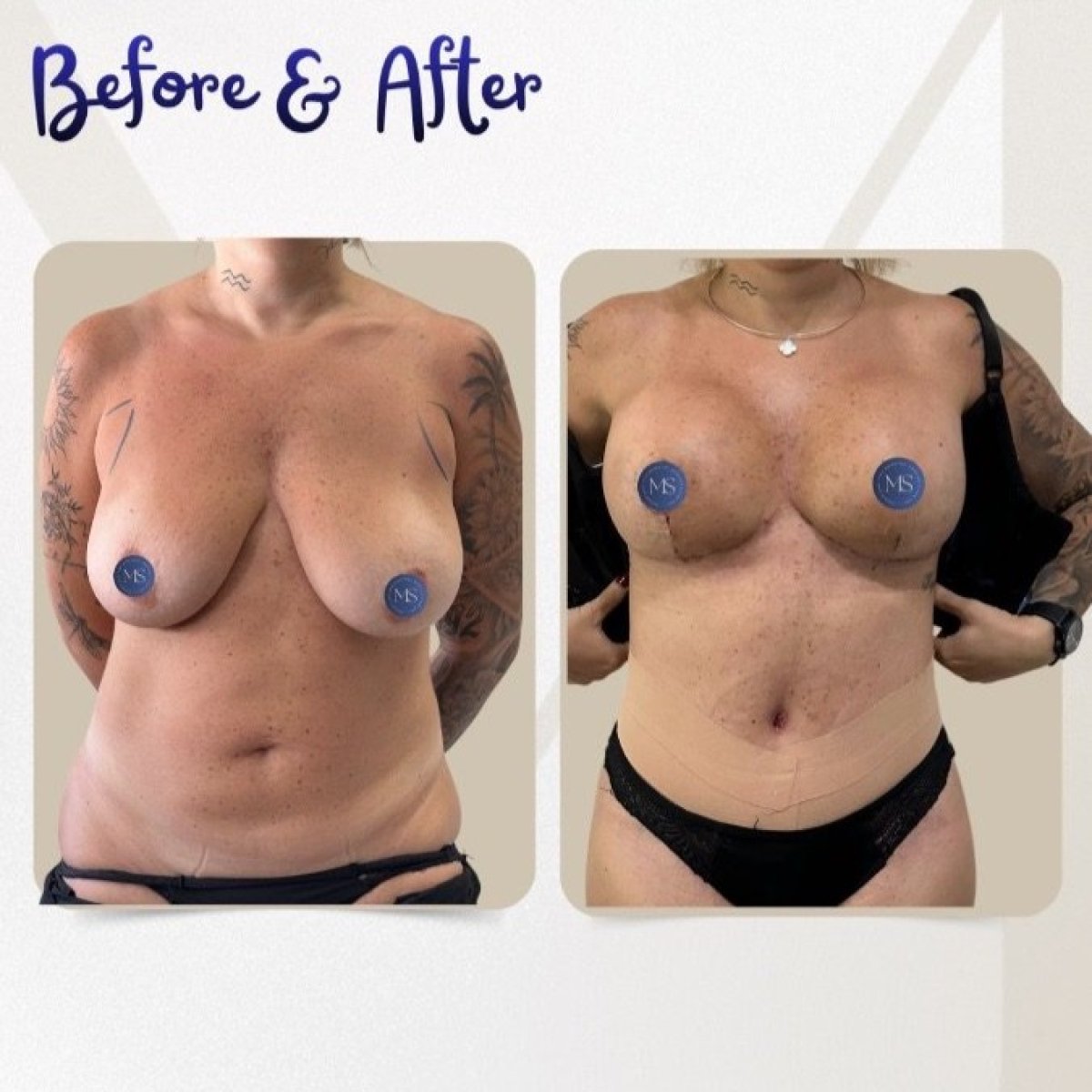 نتائج شفط الدهون قبل وبعد في عيادة Dr. Michel Salameh - Plastic And Aesthetic Surgery