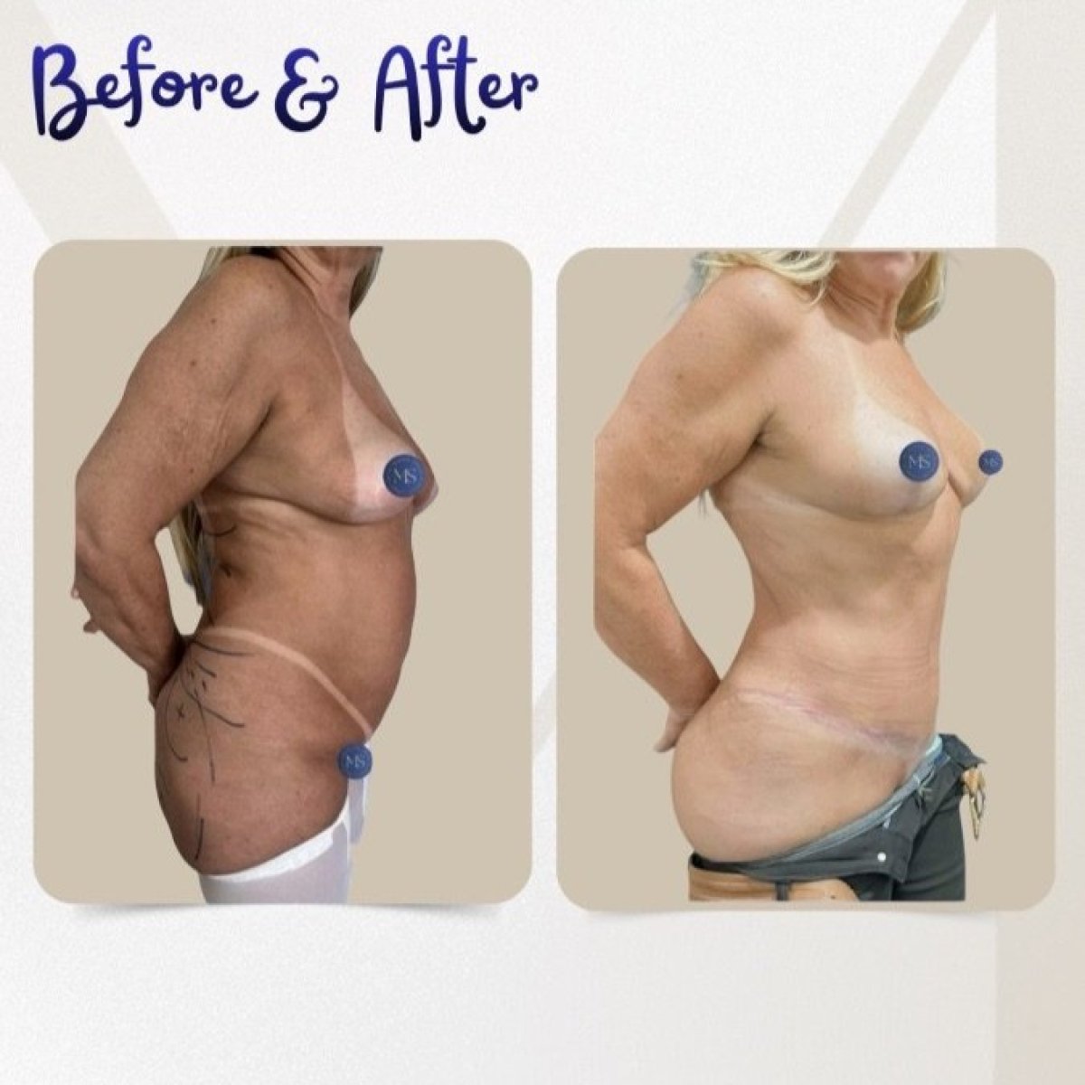 نتائج شفط الدهون قبل وبعد في عيادة Dr. Michel Salameh - Plastic And Aesthetic Surgery