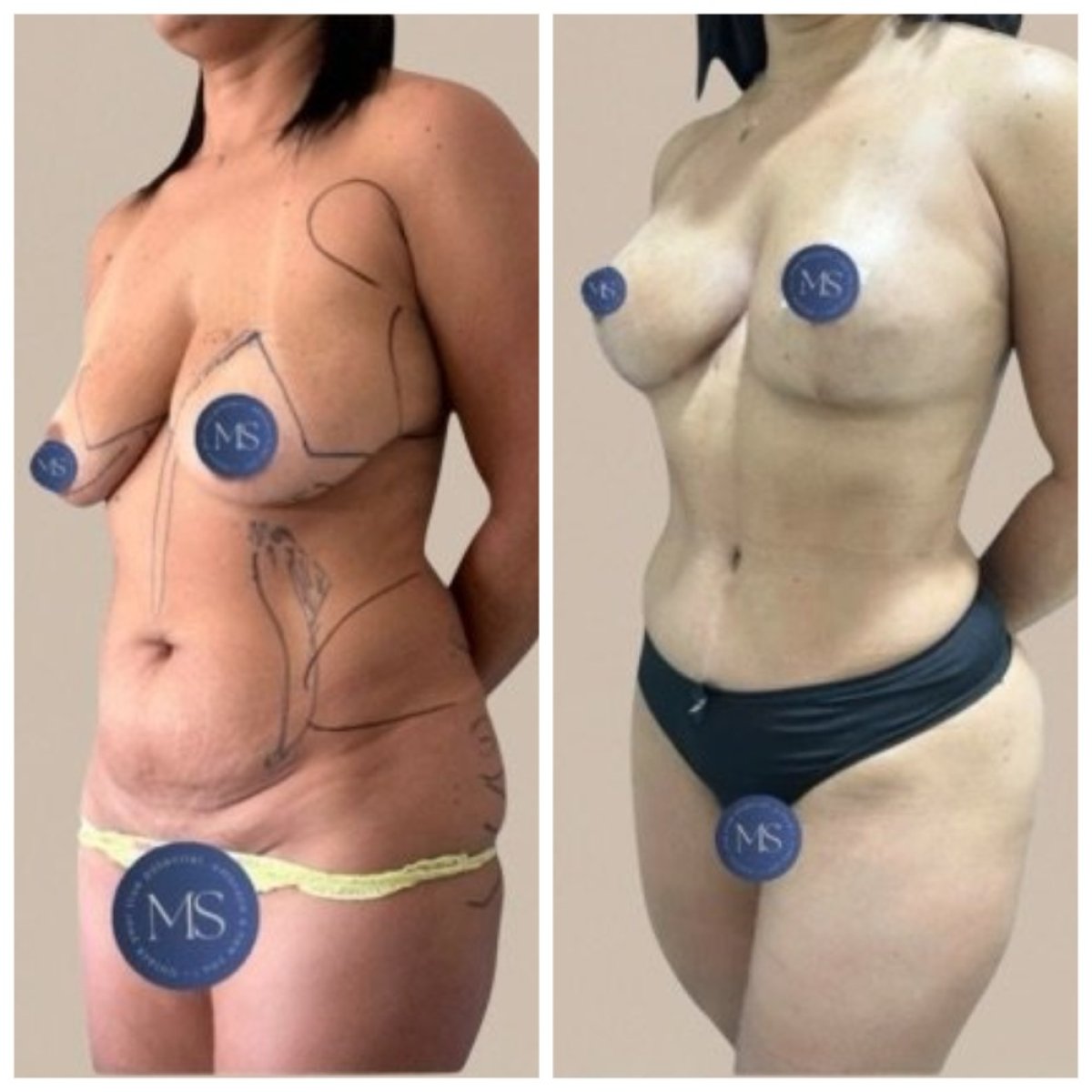نتائج شفط الدهون قبل وبعد في عيادة Dr. Michel Salameh - Plastic And Aesthetic Surgery