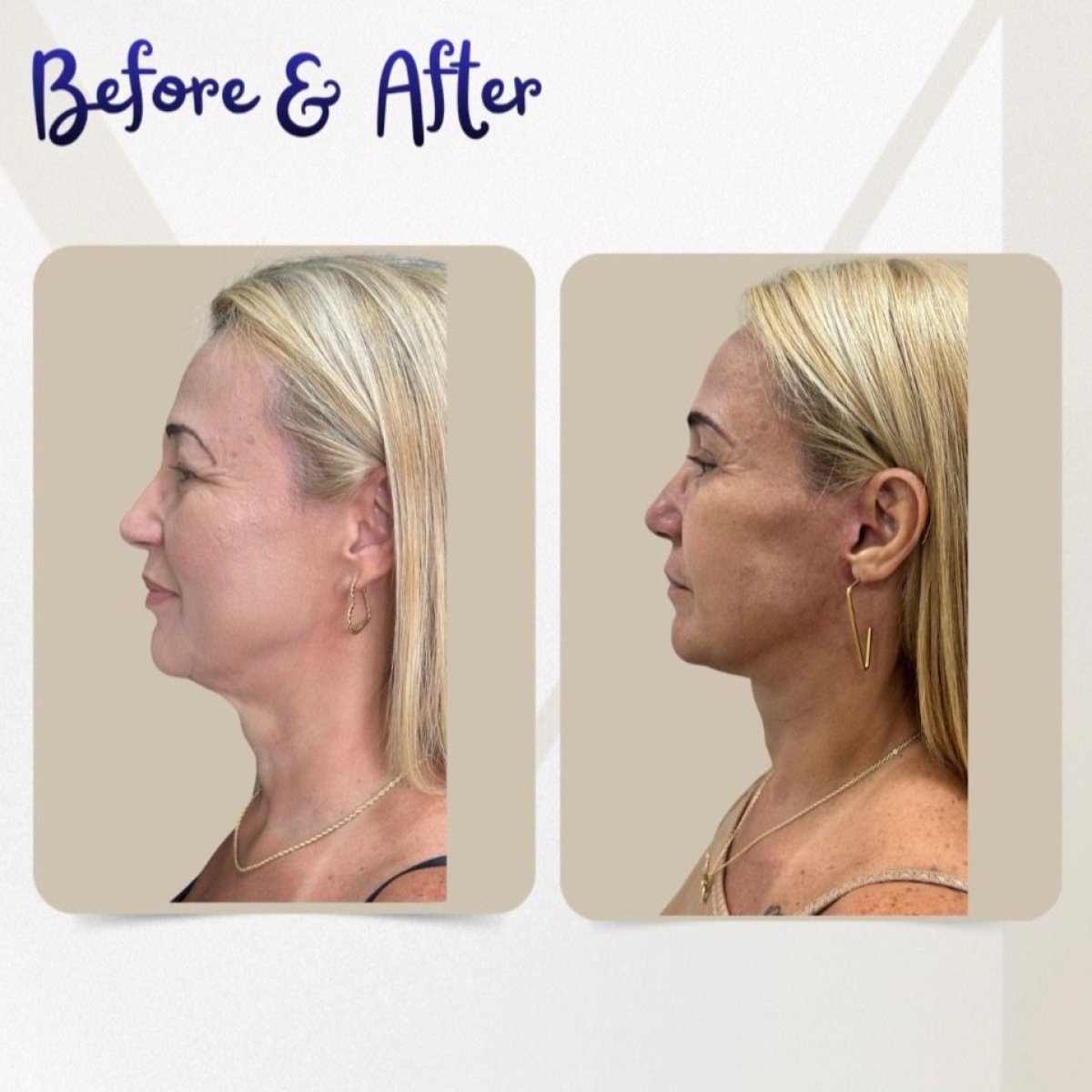 Resultados de blefaroplastia antes y después en Dr. Michel Salameh - corrección de párpados