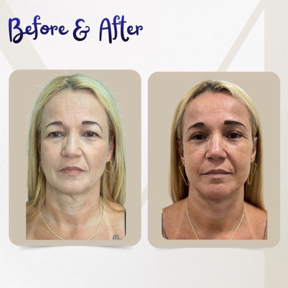 Resultados de blefaroplastia antes y después en Dr. Michel Salameh - Plastic And Aesthetic Surgery