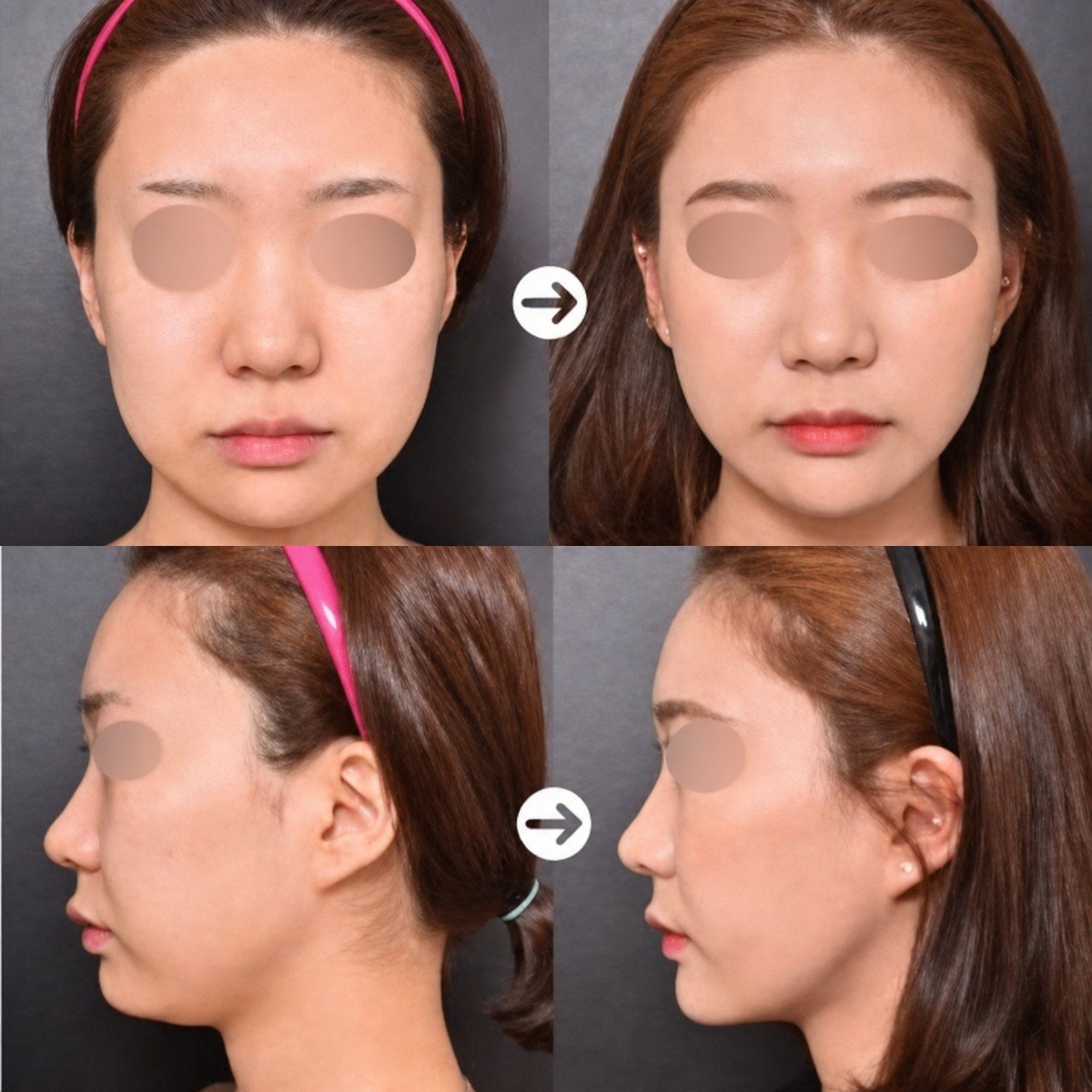 Before and after lipofilling (fat grafting) facial contouring results at VG Plastic Surgery clinic