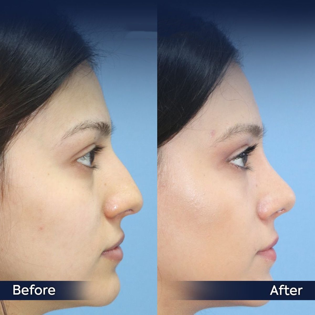 نتائج عملية تجميل الأنف قبل وبعد في عيادة Dr. Safa Manav، إعادة تشكيل الأنف بشكل طبيعي