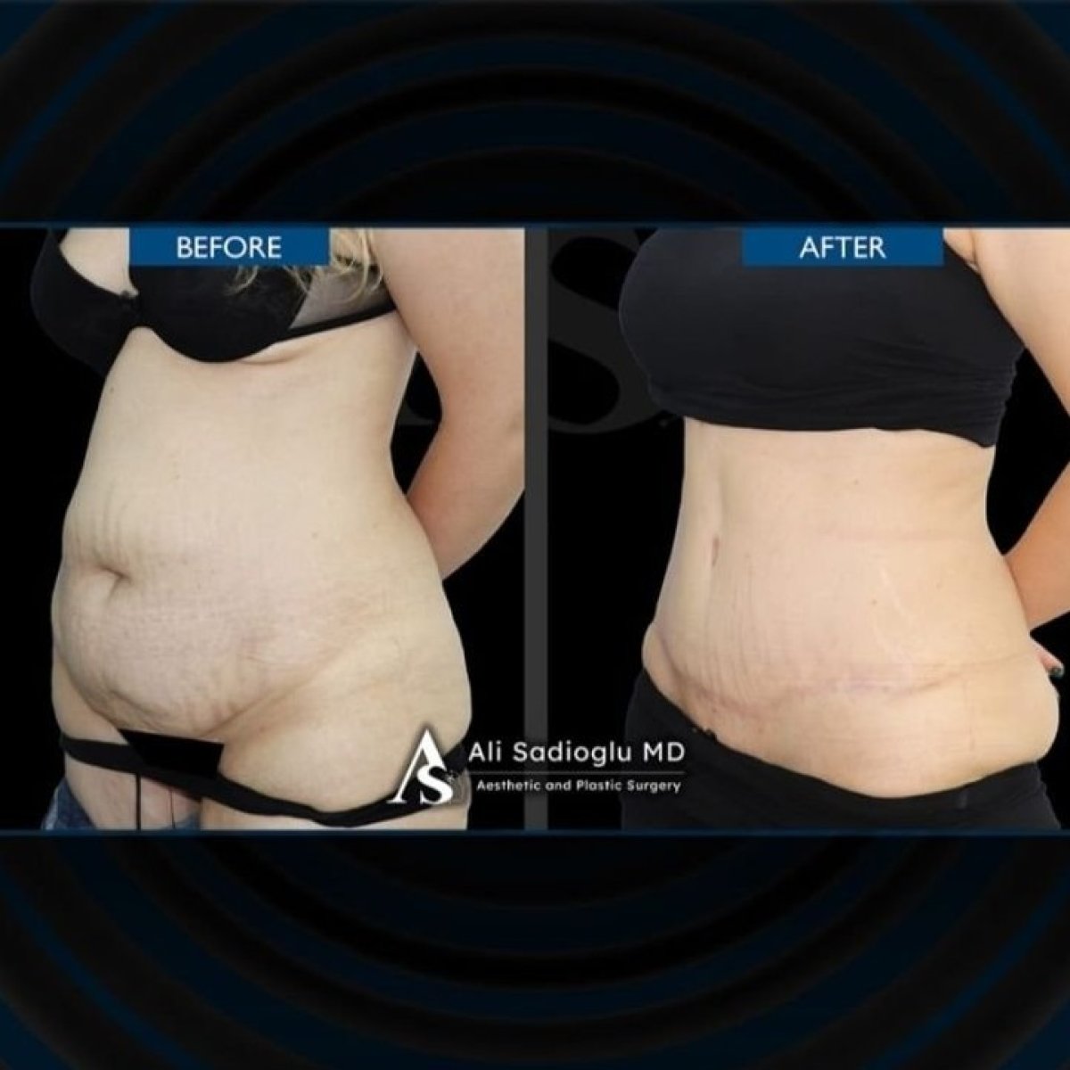 Résultats avant et après abdominoplastie à la clinique Dr. Safa Manav, remodelage visible