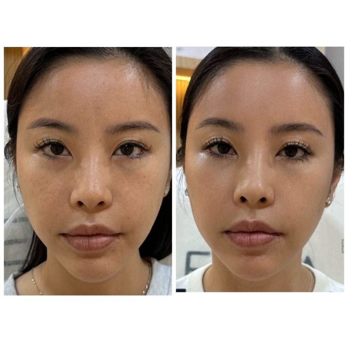 Resultado antes y después de terapia de rejuvenecimiento con células madre en EDNA Wellness