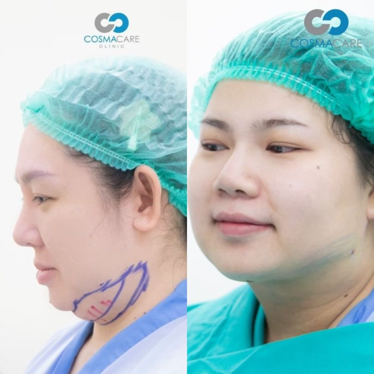 Vorher-nachher-Ergebnis Kinn-Liposuktion bei Cosmacare Clinic Center for Aesthetic Medicine