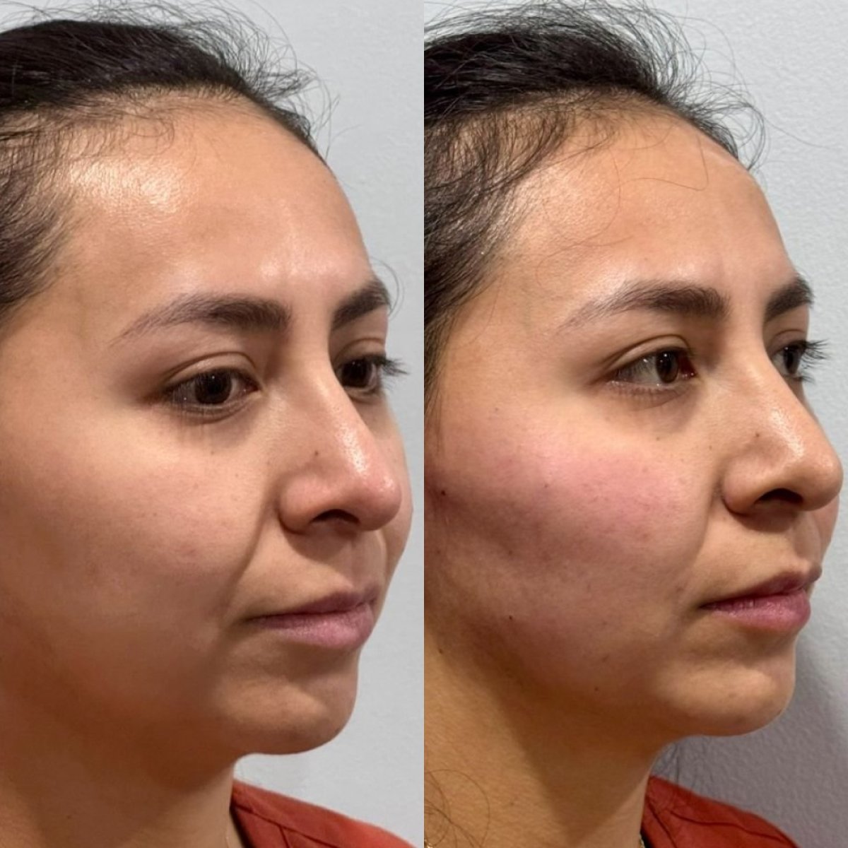 Before and after facial fat transfer results at Lucio Santos Plastic Surgery, enhanced cheek volume