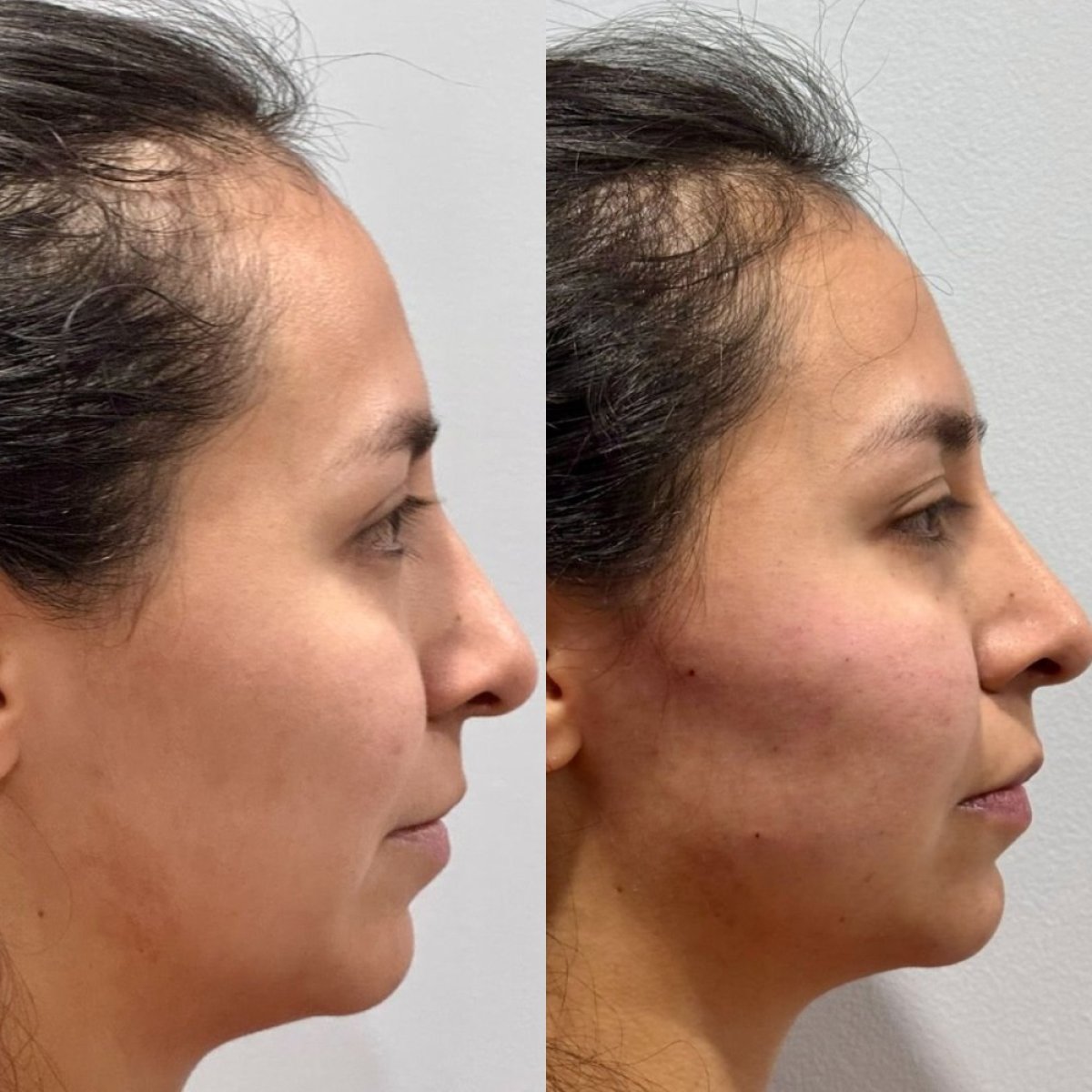 Before and after facial fat transfer at Lucio Santos Plastic Surgery, enhanced cheek volume result