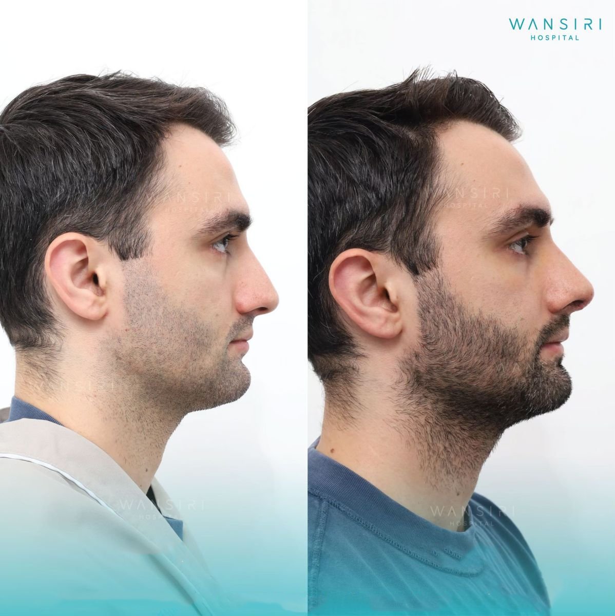 Résultats avant et après rhinoplastie à Wansiri Hospital, profil nasal masculin amélioré