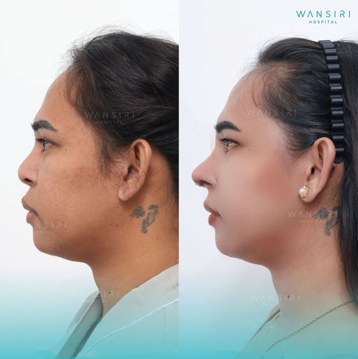 Resultados de rinoplastia antes y después en Wansiri Hospital, perfil nasal mejorado