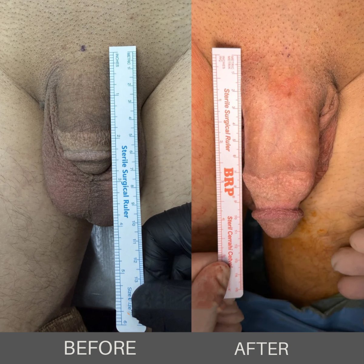 Résultats avant et après l’agrandissement du pénis chez Safe Urology, longueur accrue visible