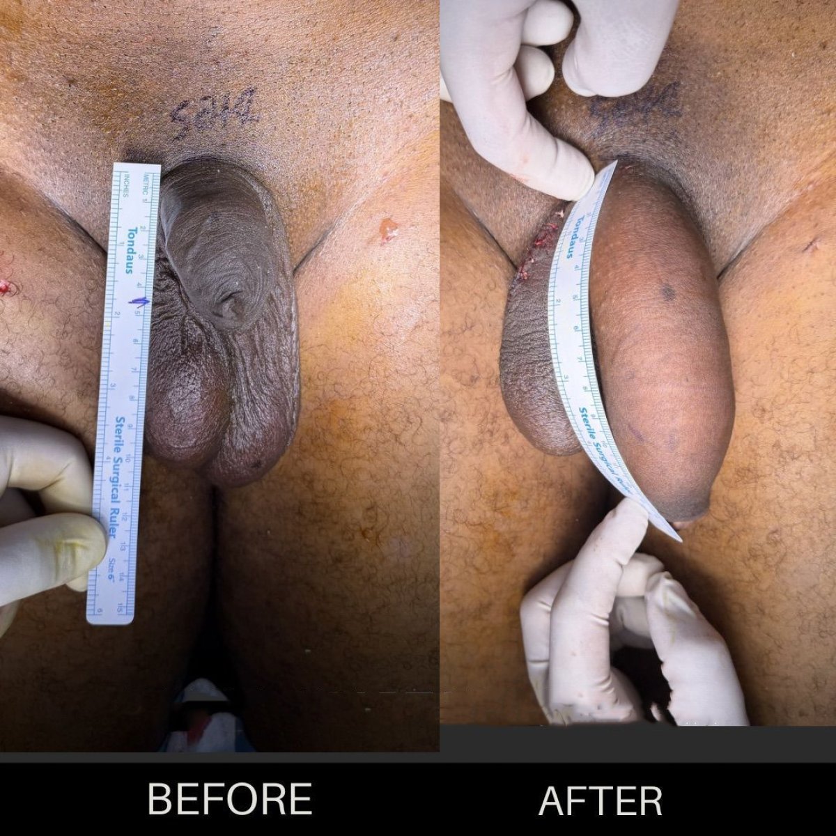 Before and after penis enlargement results at Safe Urology, visible increase in length and girth