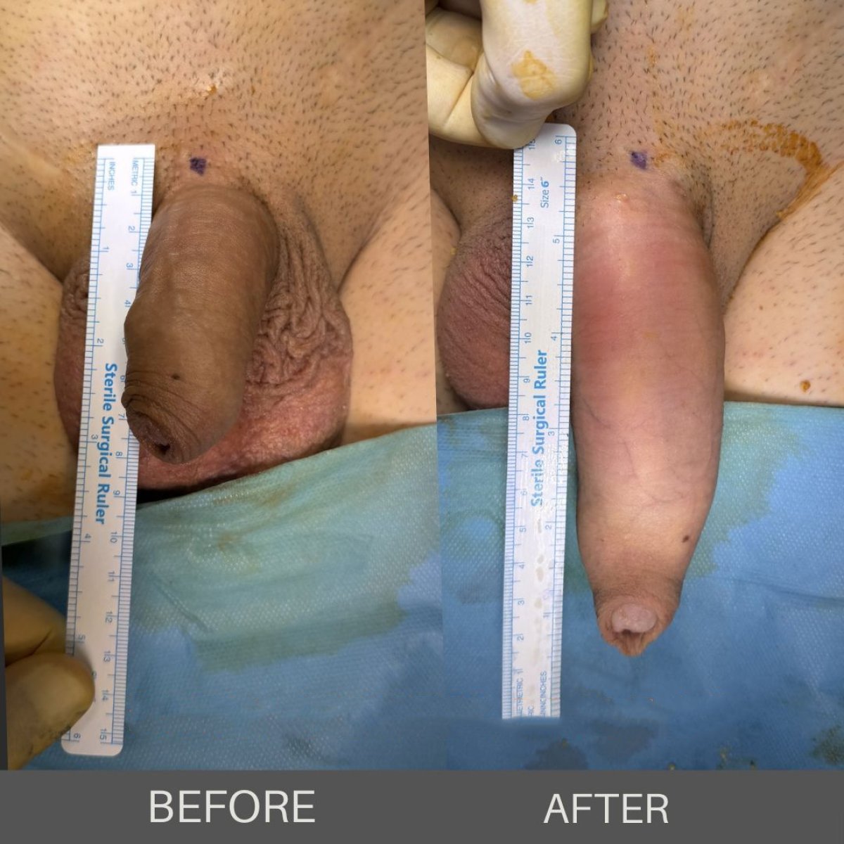 Before and after penis enlargement results at Safe Urology, visible increase in length and girth