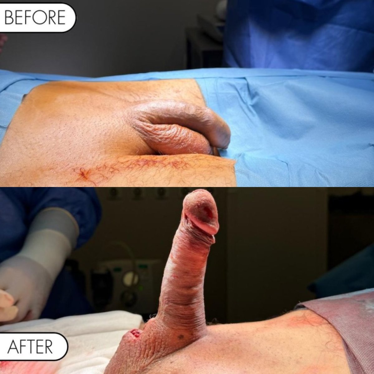 Vorher-nachher-Ergebnisse der Penisprothese bei Safe Urology – verbesserte Erektionsfunktion