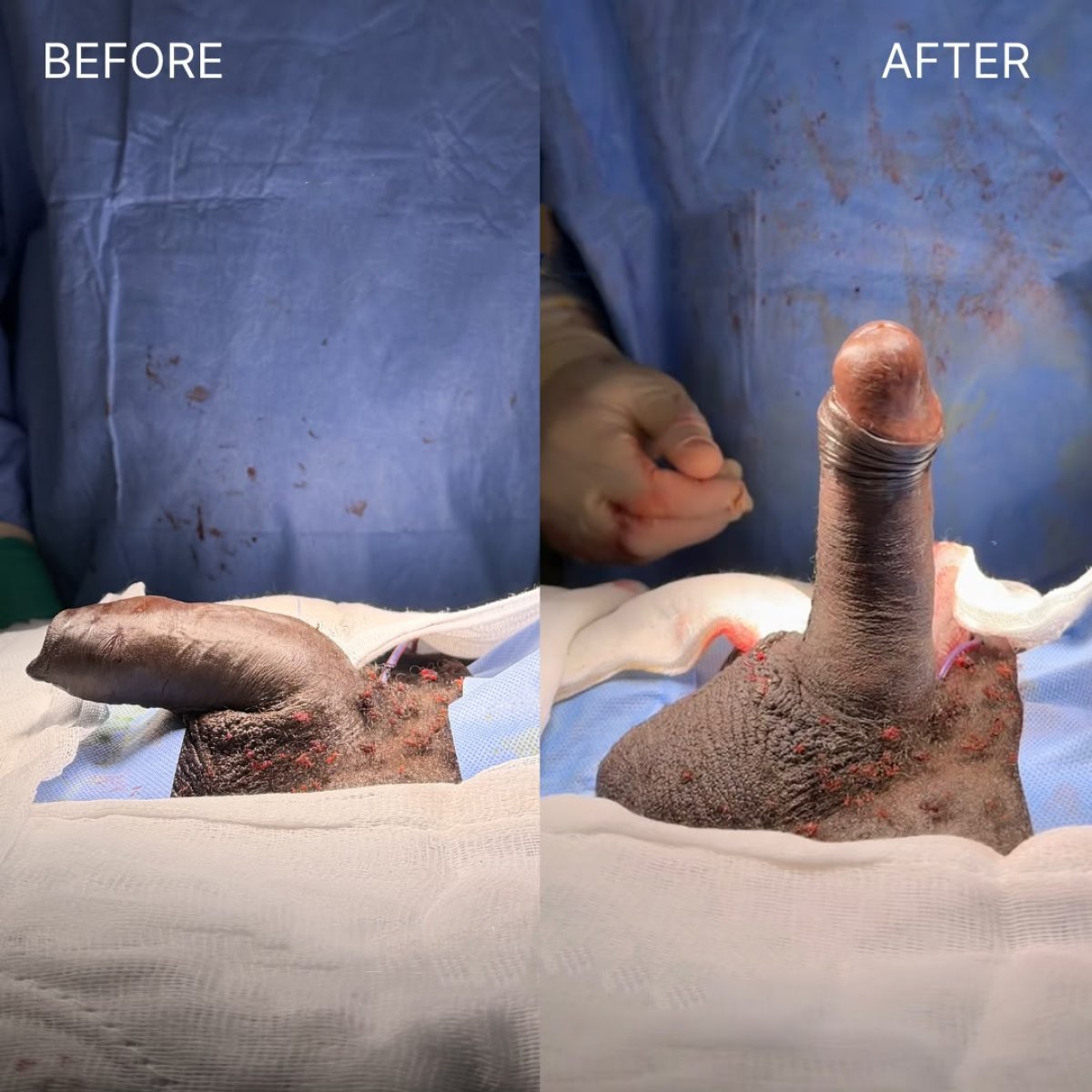 Vorher-nachher-Ergebnis Penisimplantat-OP bei Safe Urology, verbesserte Erektionsfunktion