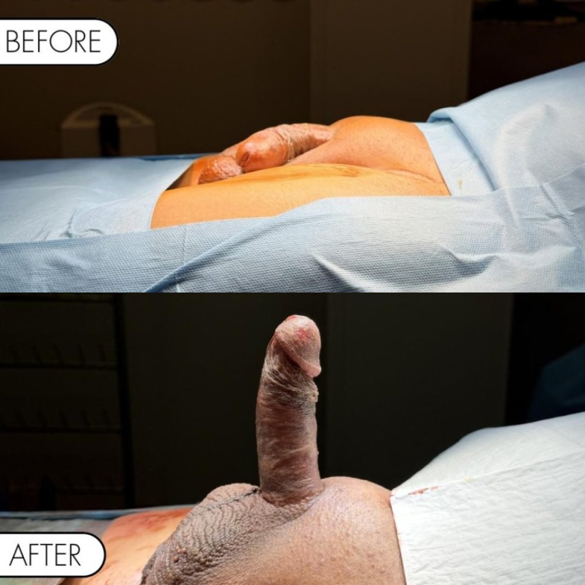 Before and after penile implant surgery results at Safe Urology – improved erectile function
