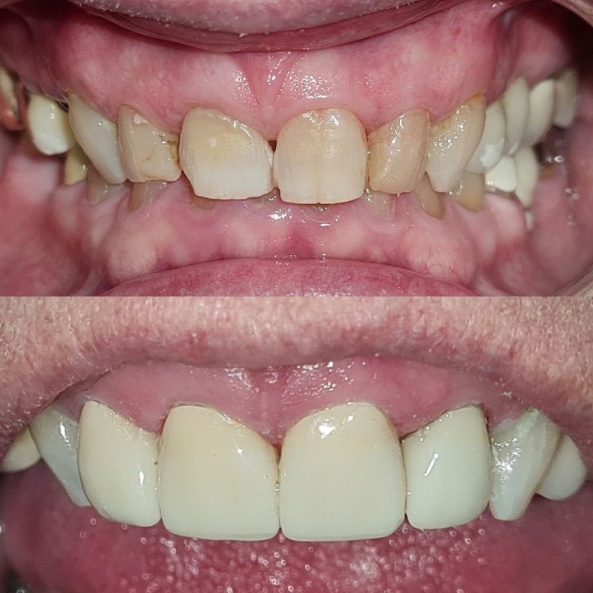 Efekty przed i po założeniu koron w SoftDentalCare Clinic, poprawiony uśmiech