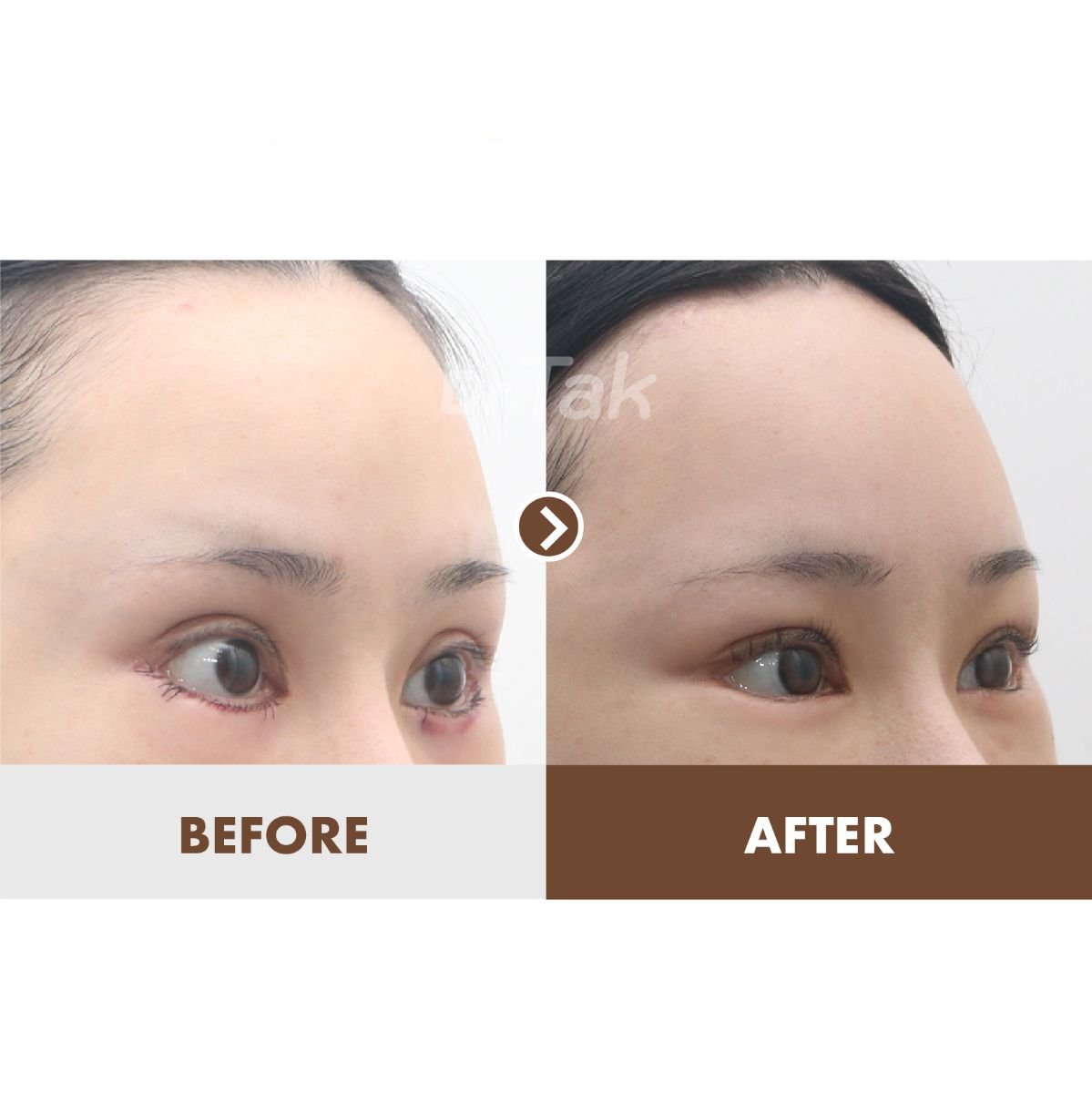 Résultats avant/après Fox Eye Lift chez Dr. Tak Plastic Surgery, paupières relevées